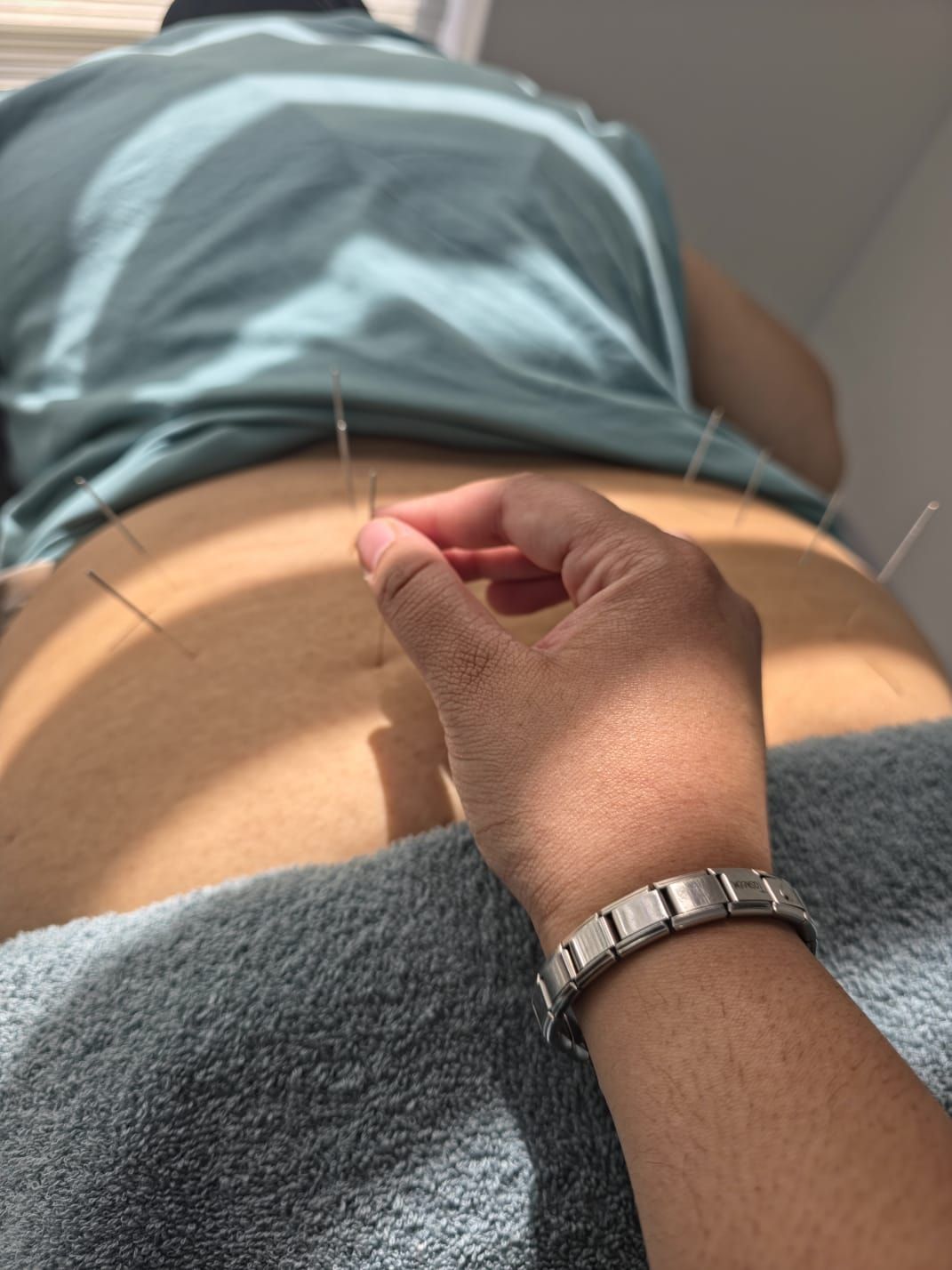 Dr Patel placing fine acupuncture needles along a patient's upper back
